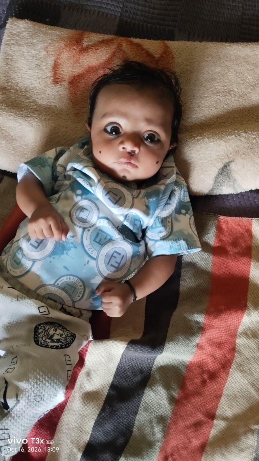 सीहोर: आरबीएसके टीम ने बच्चे का कटे होंठ-तालू ऑपरेशन कर दी नई जिंदगी